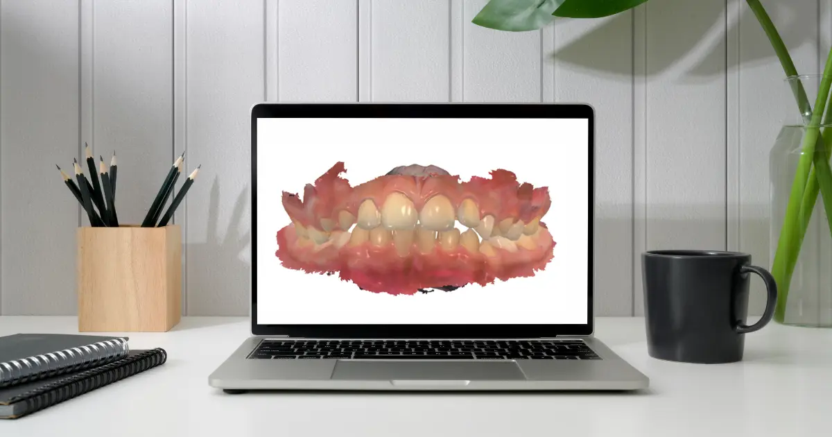 Modelo digital 3D de arcada dentária em formato STL na tela do computador